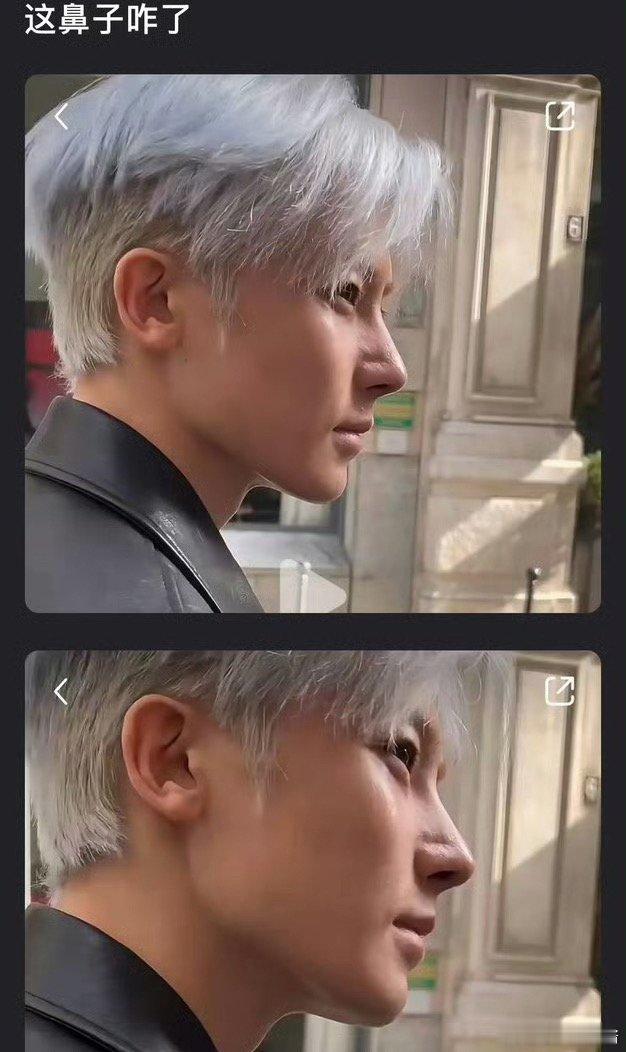 侯明昊鼻子为什么凹进去了 