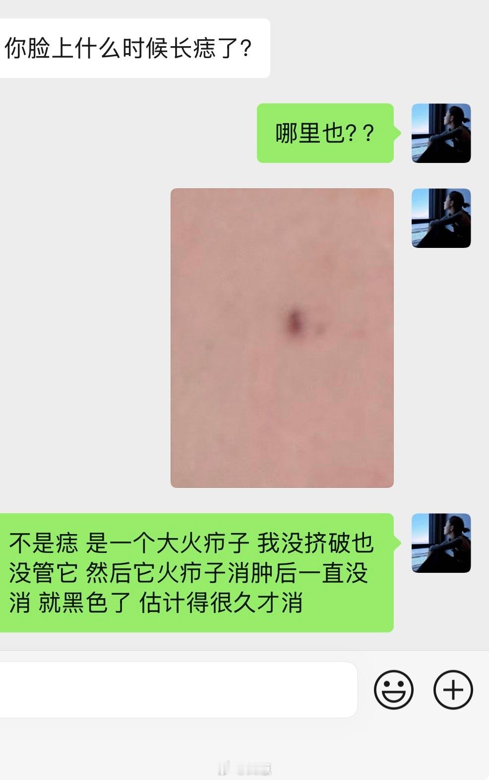 从小到大没长过什么青春痘[呵呵]快奔三了长火疖子[捂嘴哭]还他妈消不下去[捂嘴哭