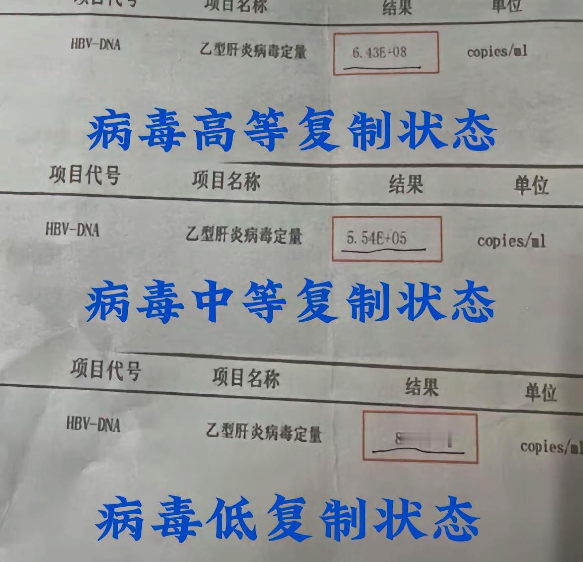 乙肝病毒量怎么看？
临床上将乙肝病毒量的高低分为3个阶段：
第一阶段：高病毒载量
