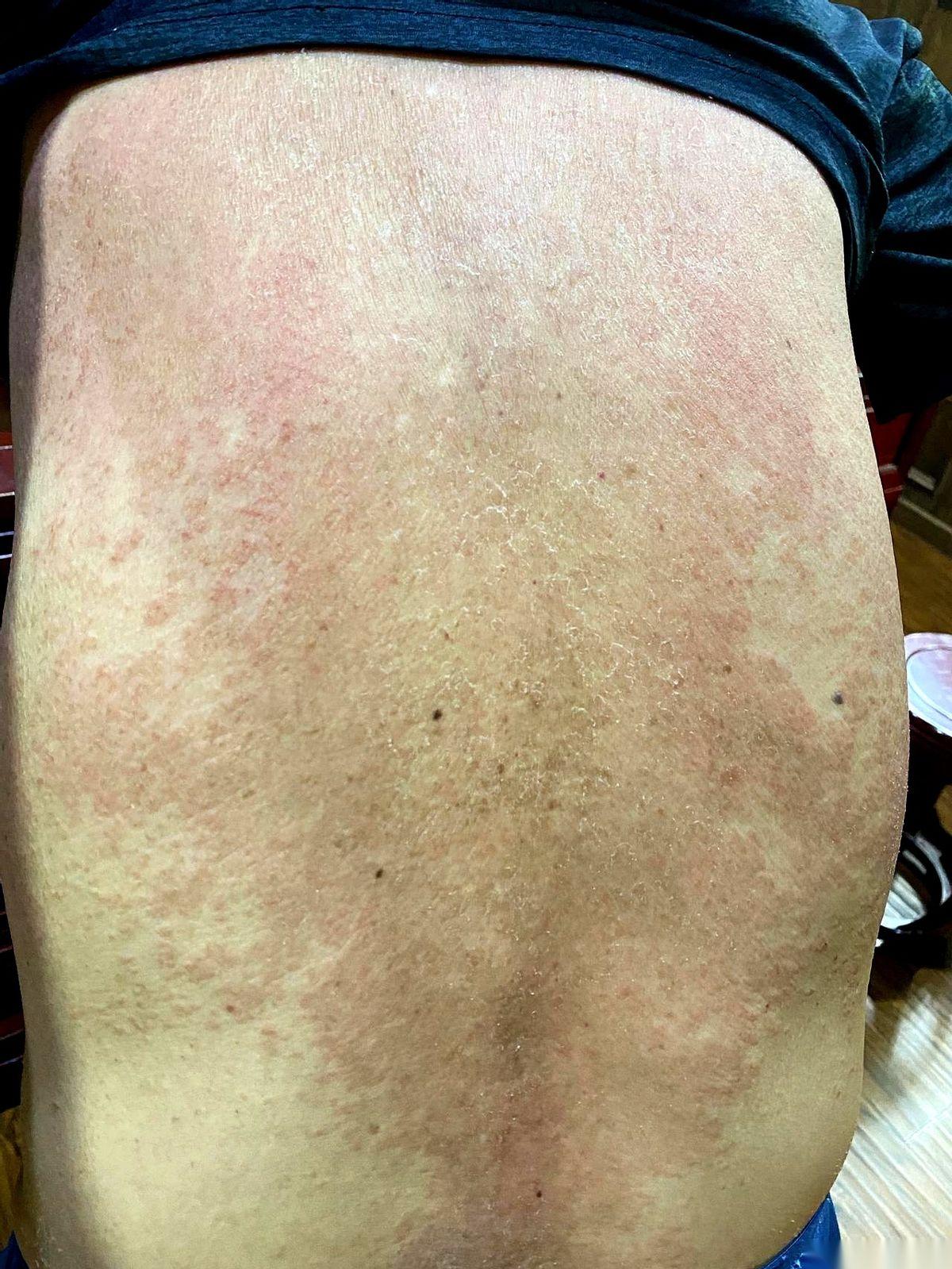 半夜，真的就是半夜，能活活把自己挠醒。
小腿上那股子钻心的痒，跟几百只蚂蚁在上面