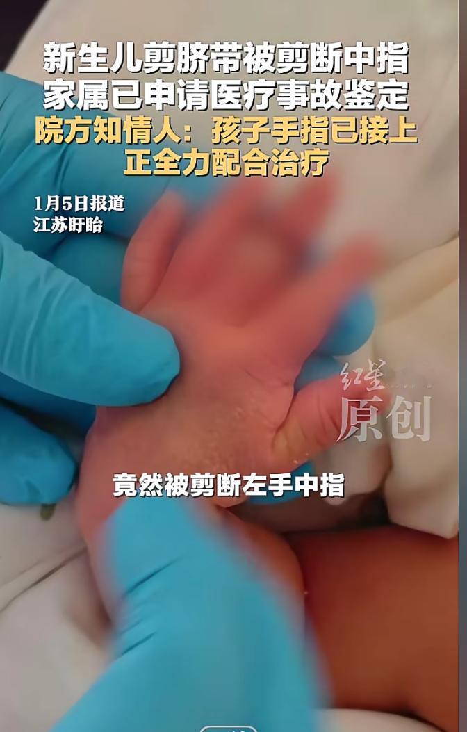 太离谱了，新生儿剪脐带竟然被剪断中指，这错误也太离谱了。

2025年12月25