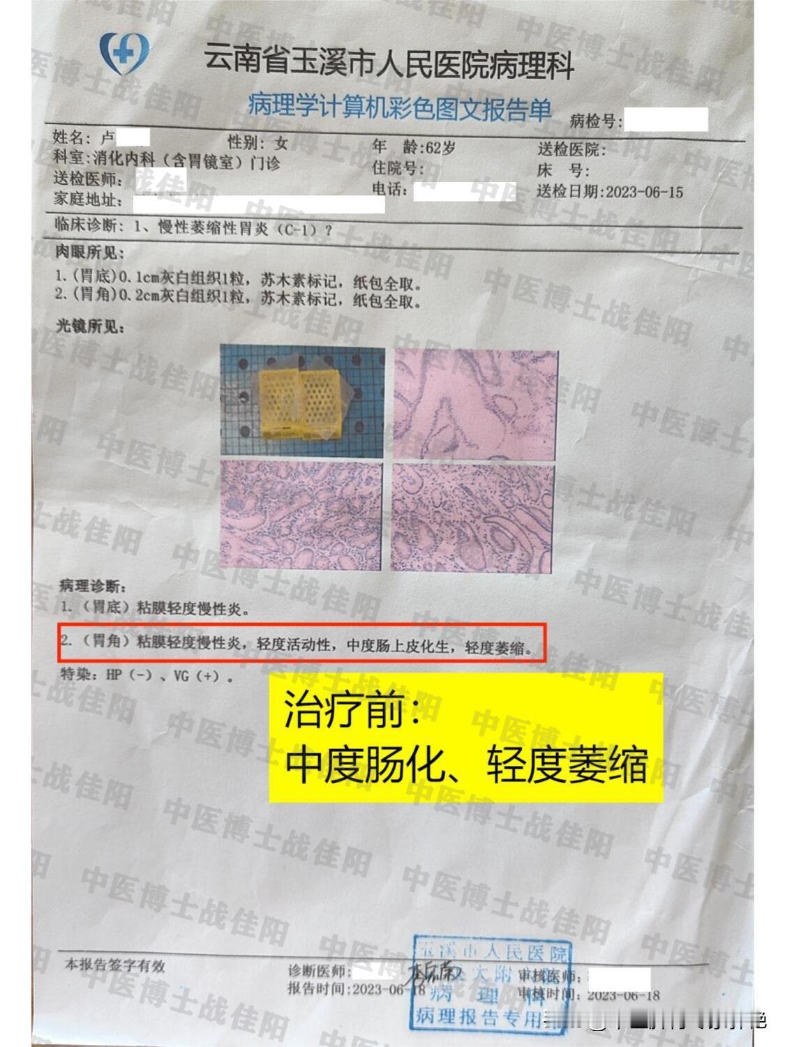 萎缩性胃炎伴肠化， 用时3个月， 诸状皆消

刘女士，62来岁，之前是个大公司的