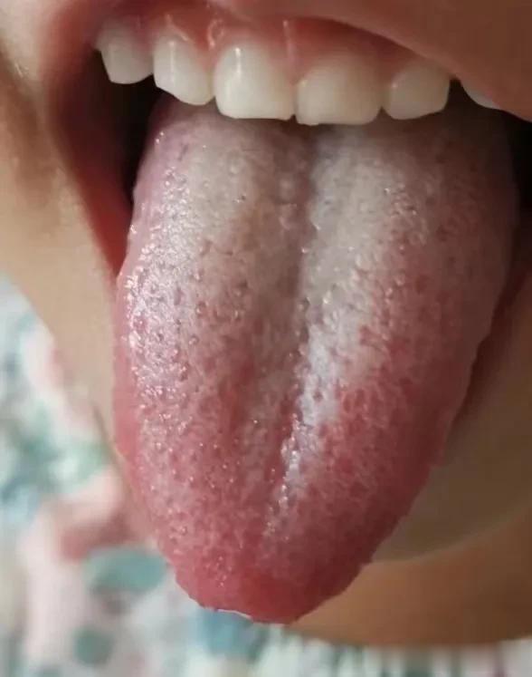 教你看孩子的舌苔【案例一】

这个女孩将近4岁，典型的草莓舌，同时中间又偏厚一些
