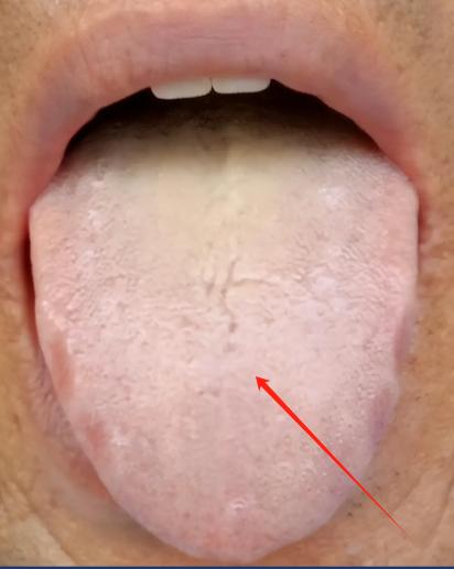 你是否也曾为舌苔白厚、痰湿重而苦恼
吃了二陈丸和参苓白术，健脾化痰的效果却不尽如