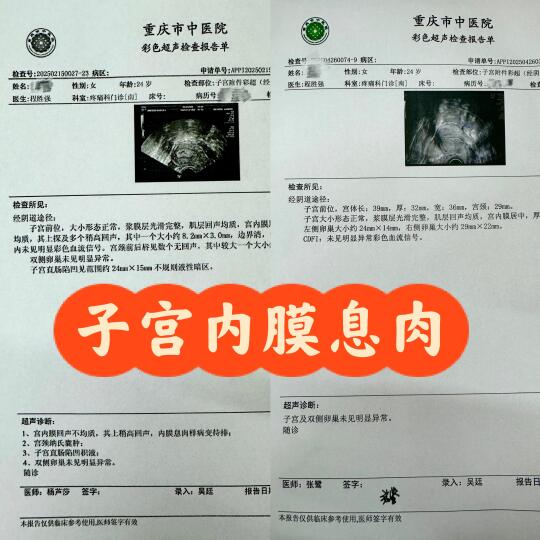 子宫内膜息肉