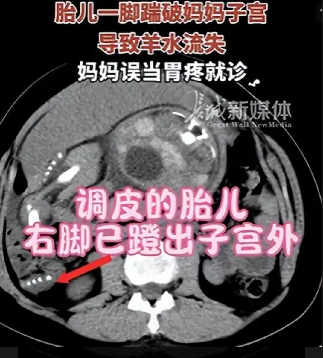 真是解释不清了
现实版的“魔童降世”!
近日，杭州一孕妈妈孕晚期第35周遭遇羊水