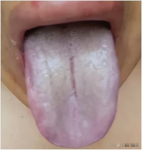 这种舌头拖的越久，麻烦就越大，调理就越难！
因为这是一个集寒湿，痰湿、肝郁、血瘀