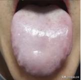 这种舌头，你要只知道健脾利湿，就大错特错了！寒到最后，必有淤！
病人主诉：全身没