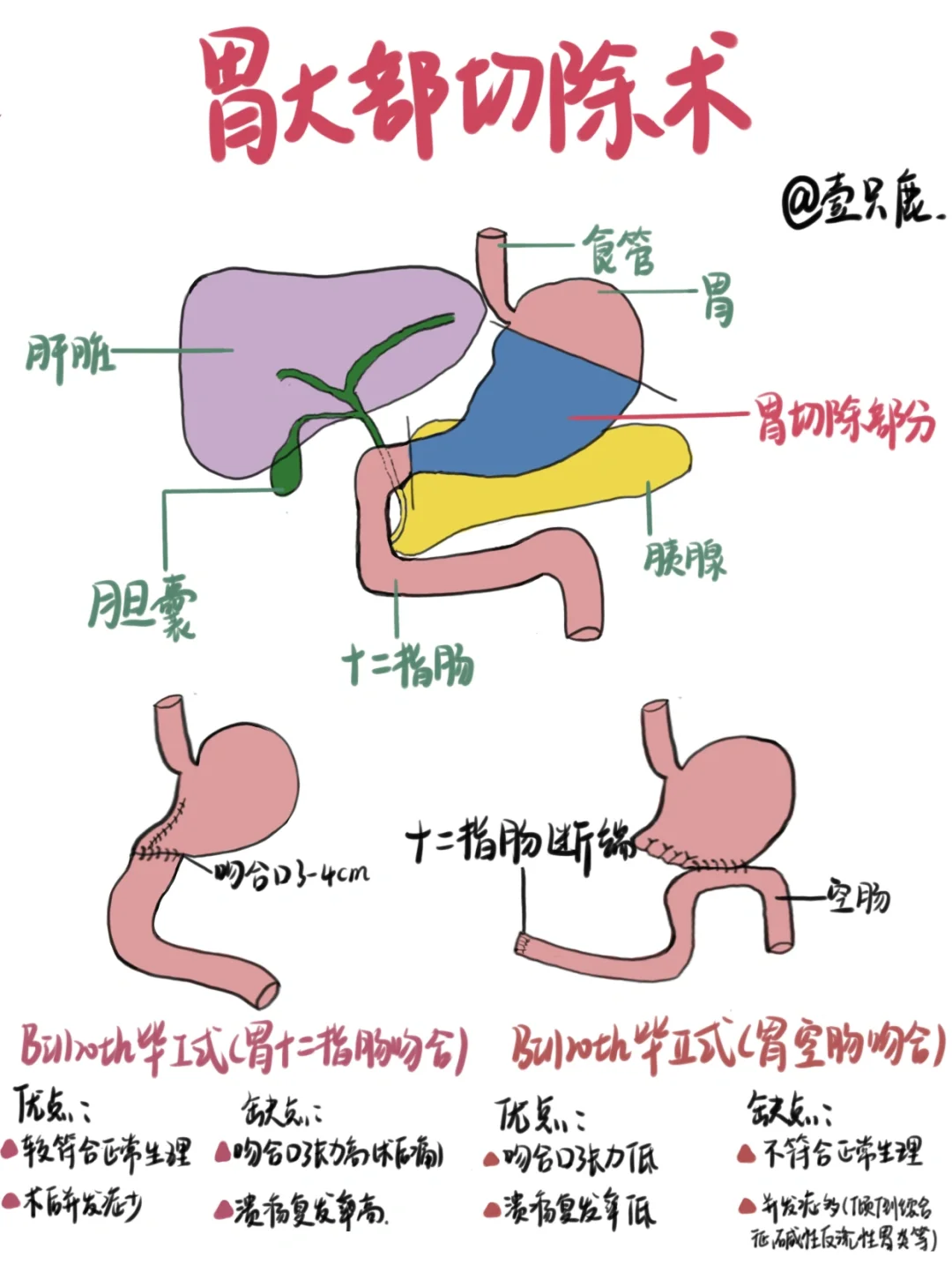 医学生笔记📒｜胃大部切除术🧐