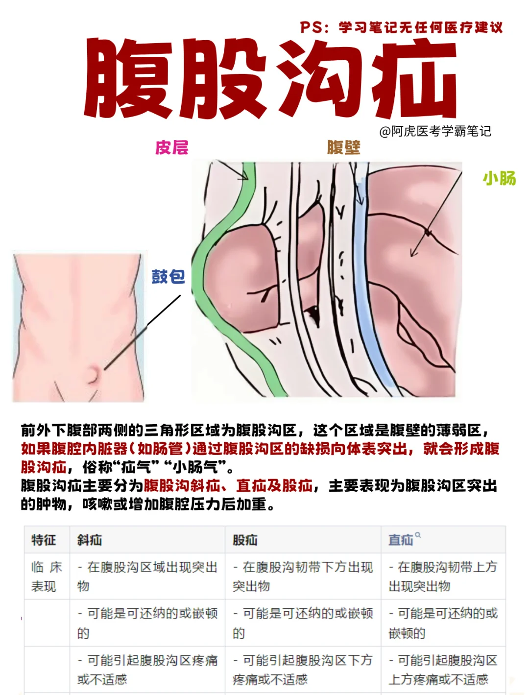 医学生笔记📒｜腹股沟疝👆