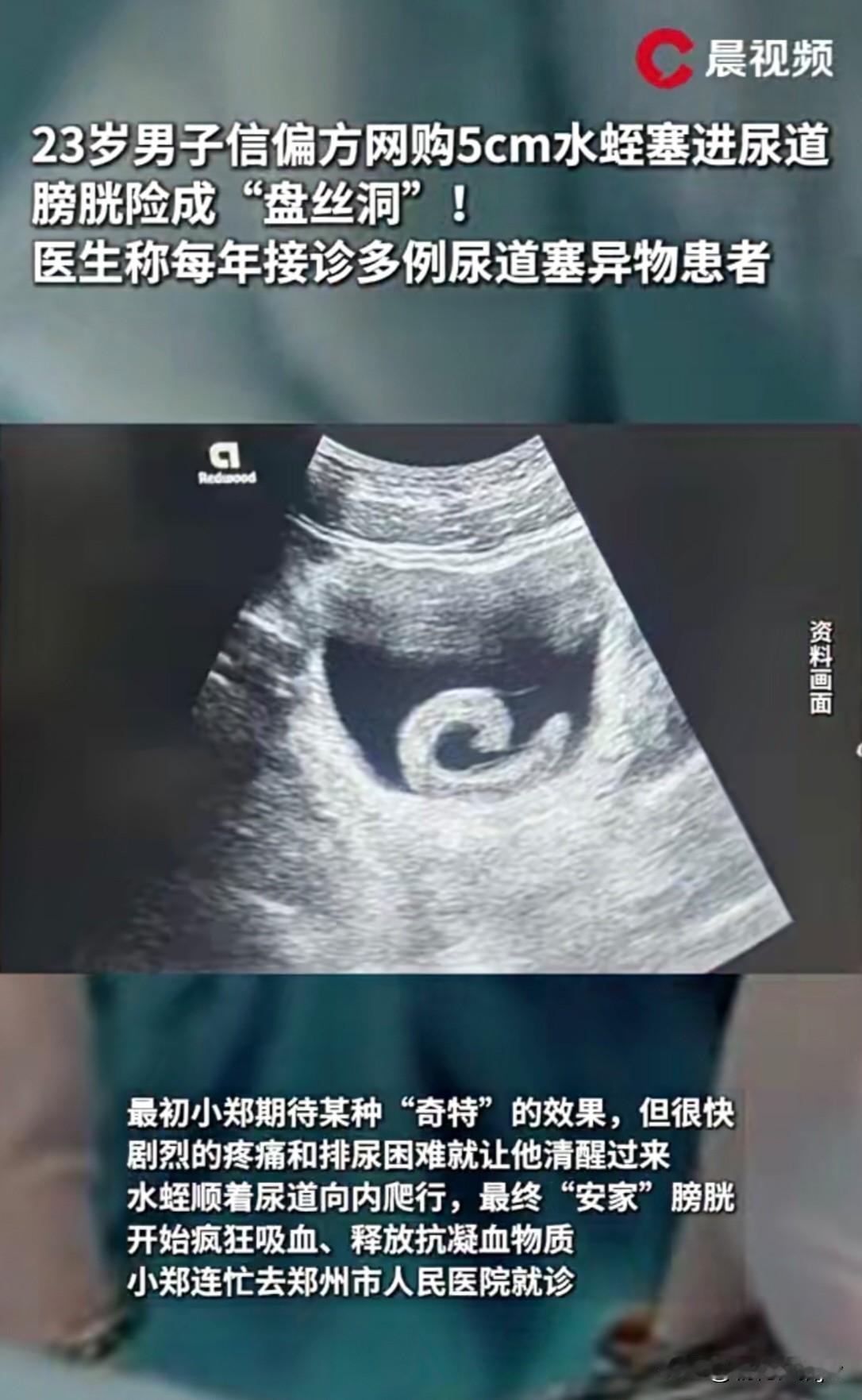 真是好奇害死猫！

郑州23岁小郑听信“偏方”，出于好奇网购了一条5㎝水蛭，并将