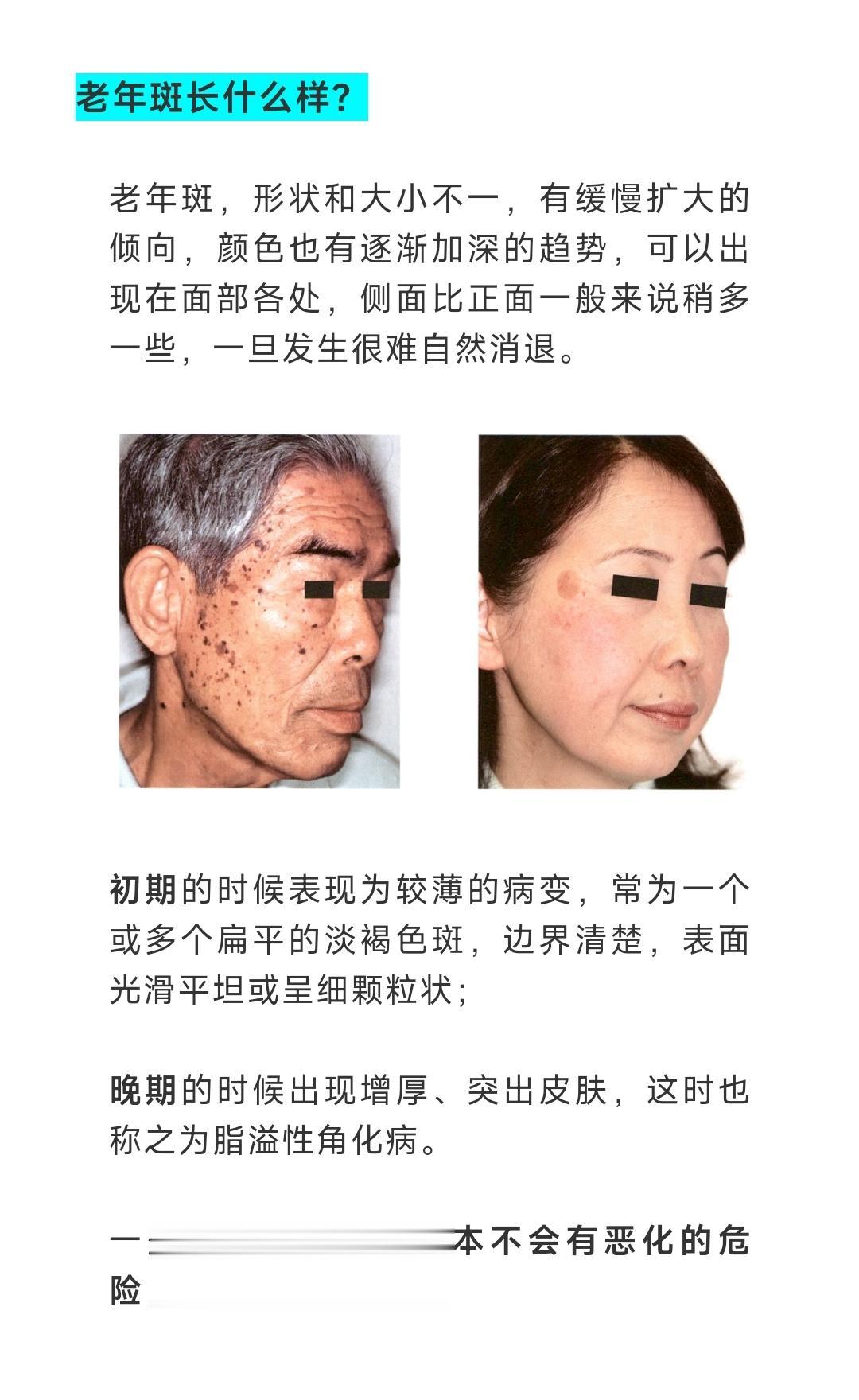 年纪轻轻就长老年斑了。老年斑，这一听就是长在“老年人“脸上的，咱又不老，怎么可以长老年斑