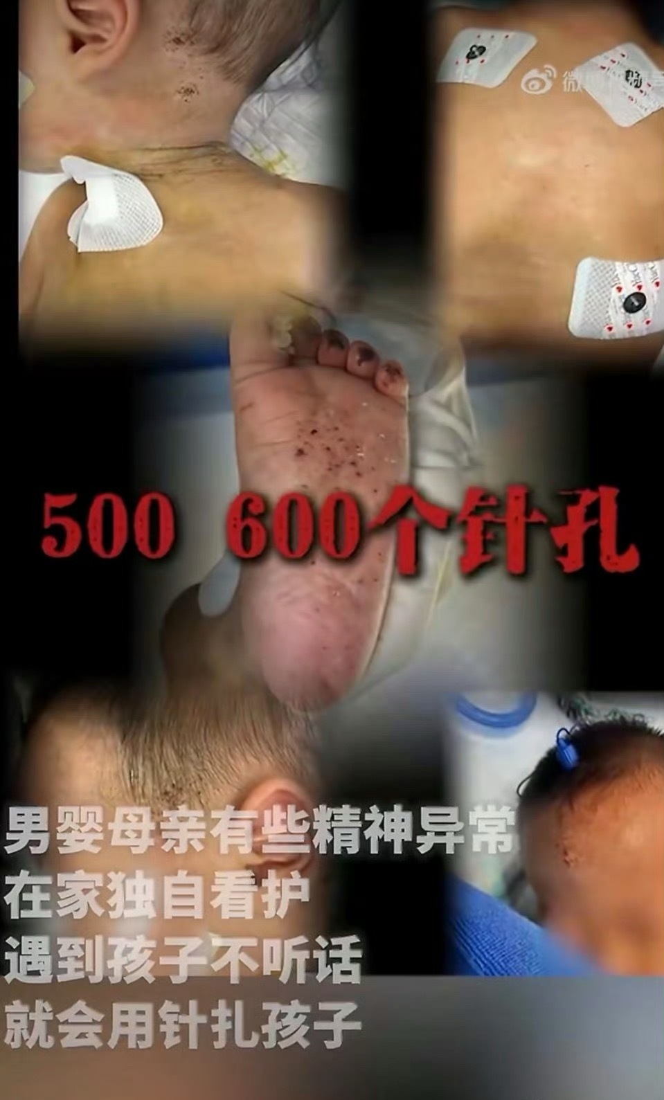 被母亲扎数百针男婴已转出ICU 数百针？？？ 