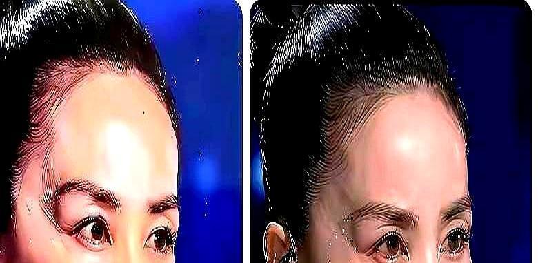 王菲脸上两条诡异蓝光，竟不是特效。
 
春晚镜头一拉近，所有人都愣了。王菲脸颊两