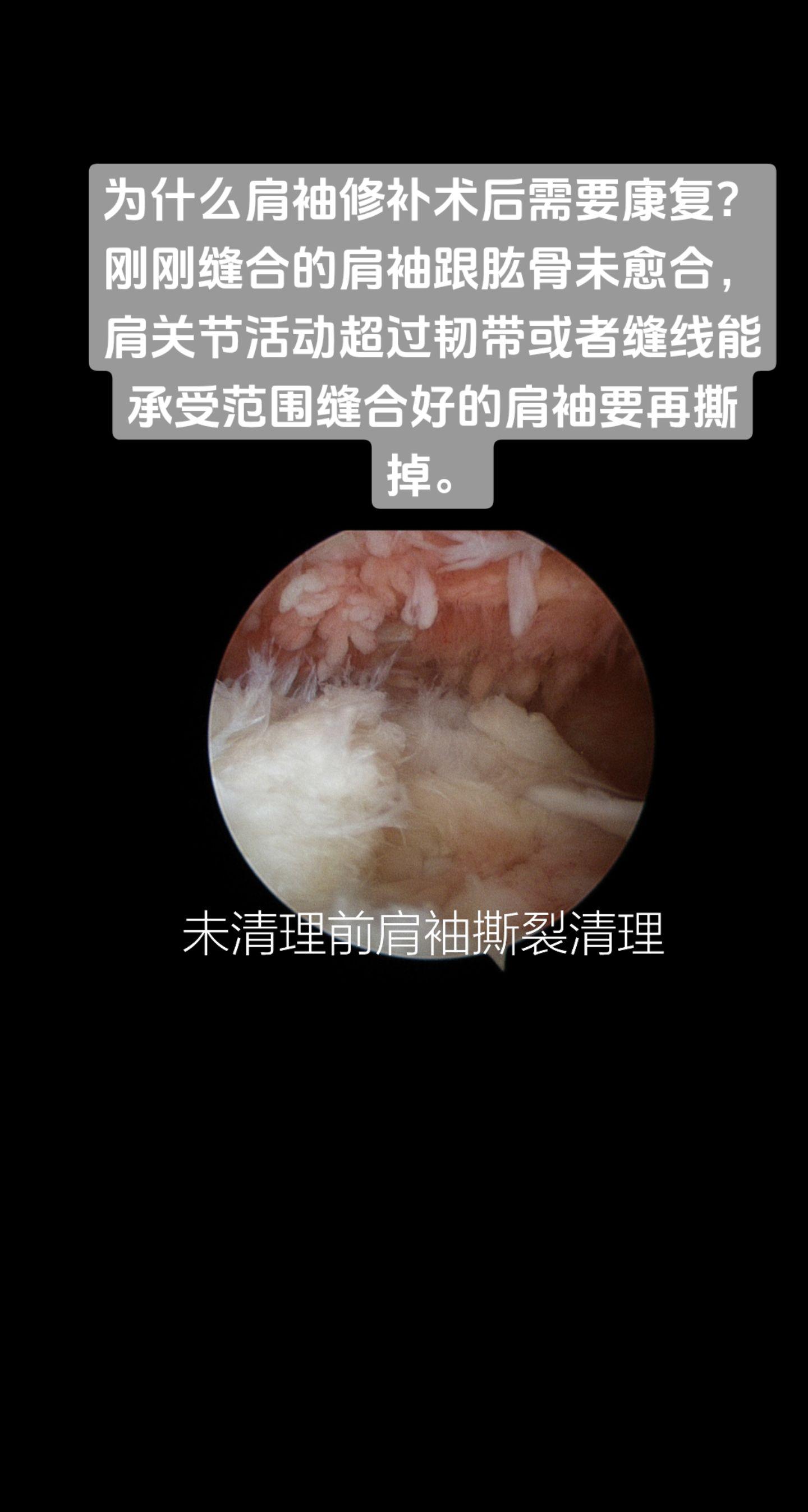 肩袖修补术后为什么要康复？