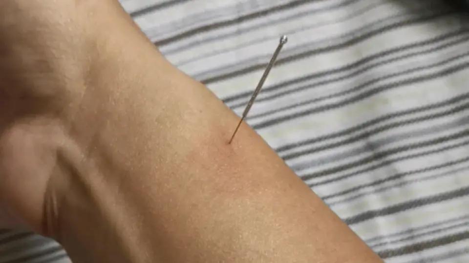 前几年有一篇针灸的论文，这篇文章的出发点是这样：以前的研究表明针灸和安慰剂效果差