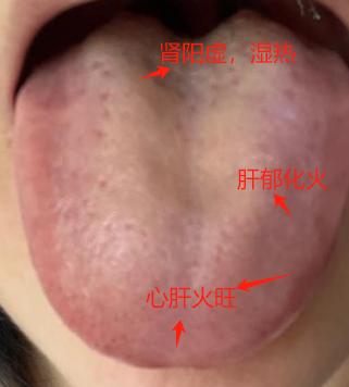 挺年轻的一个小姑娘，体内的“火”怎么这样大？舌头都红成这样了！

症状：身上很热