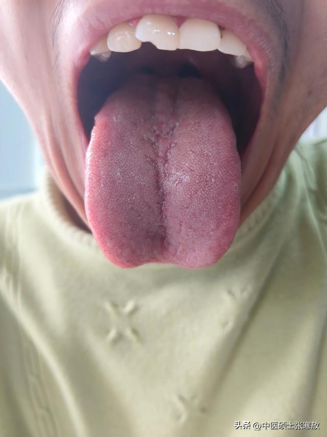 门诊患者，才刚满23，胡子还没长全，说自己肾虚了[捂脸][捂脸][捂脸]
主诉：