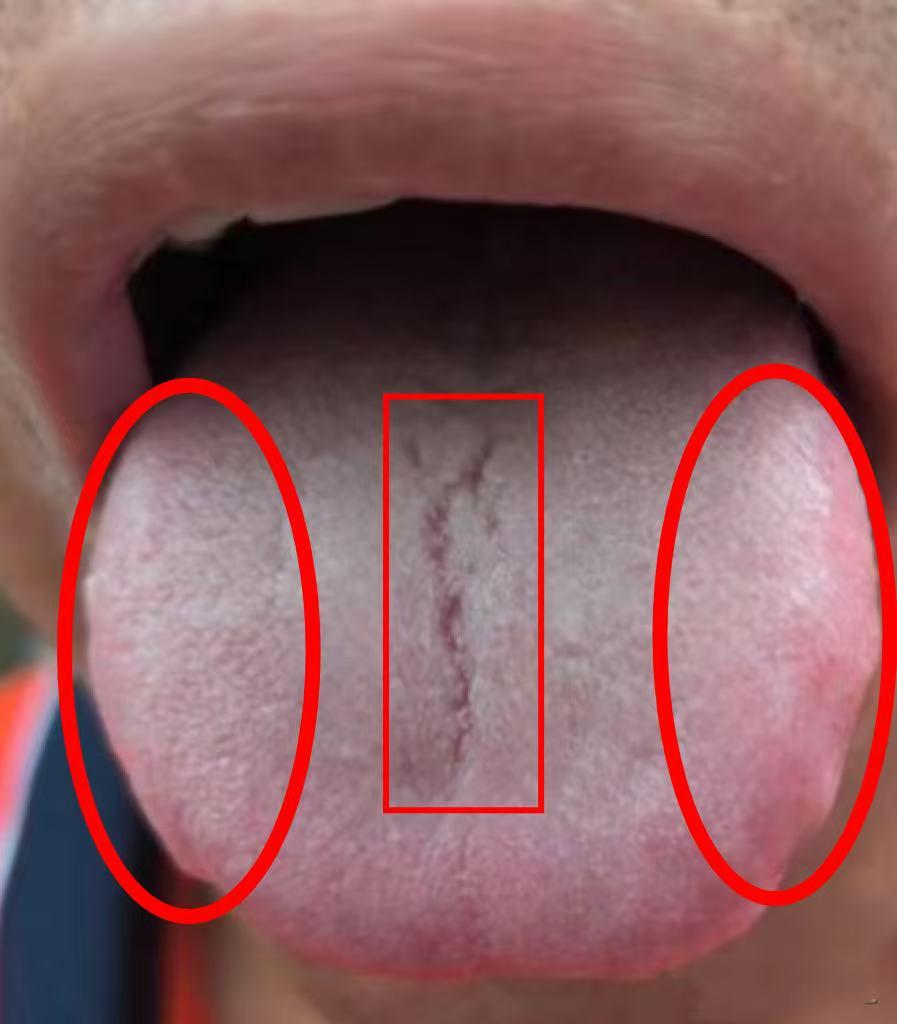 裂纹舌消不掉？记住这 2 招，四逆散配香砂六君子，气血足了，肾脏滋养了，裂纹自然