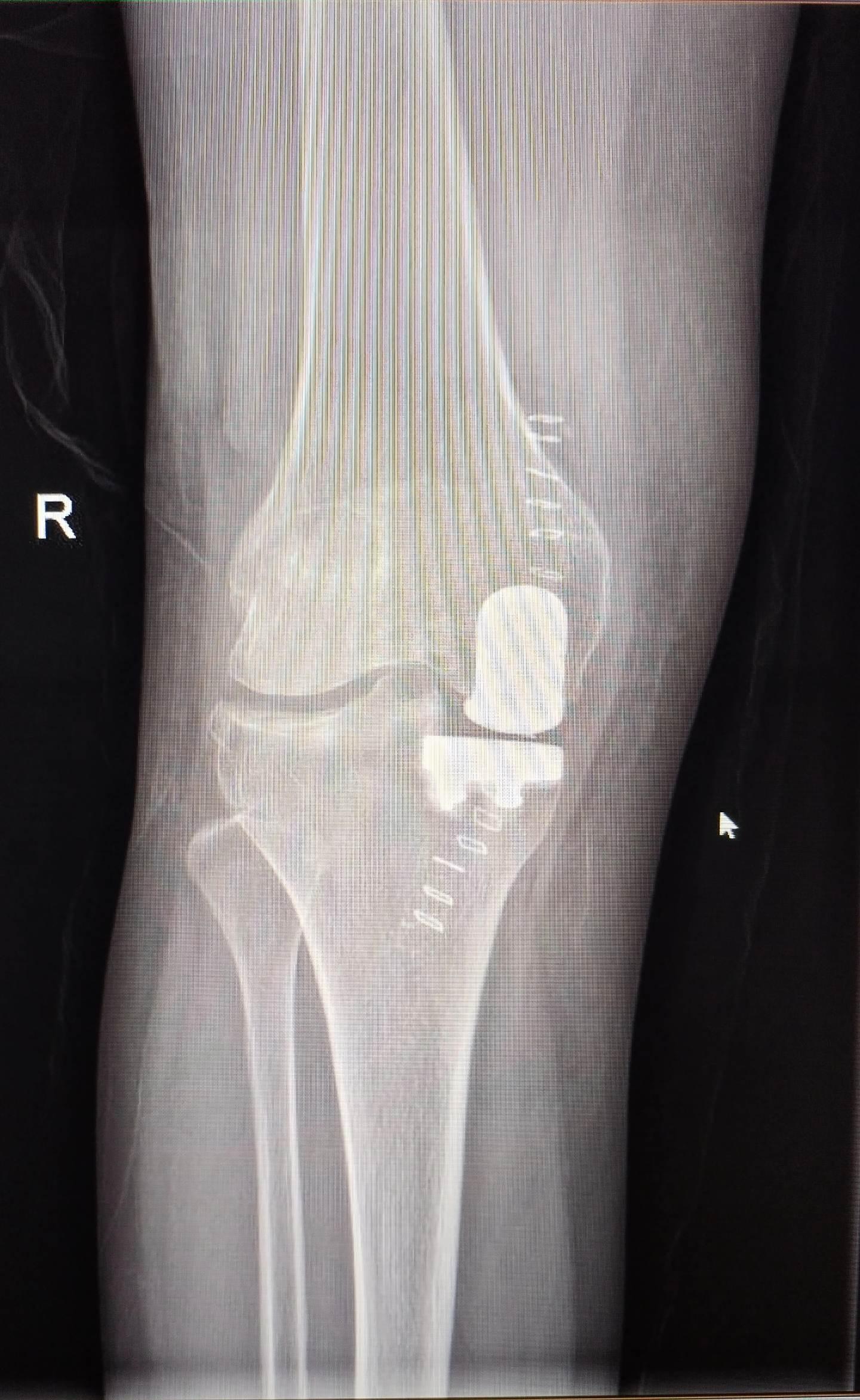 UKA单髁置换。膝关节骨关节炎，同期双侧单髁置换，术后四天出院，快速康复，省医关节外科🌹