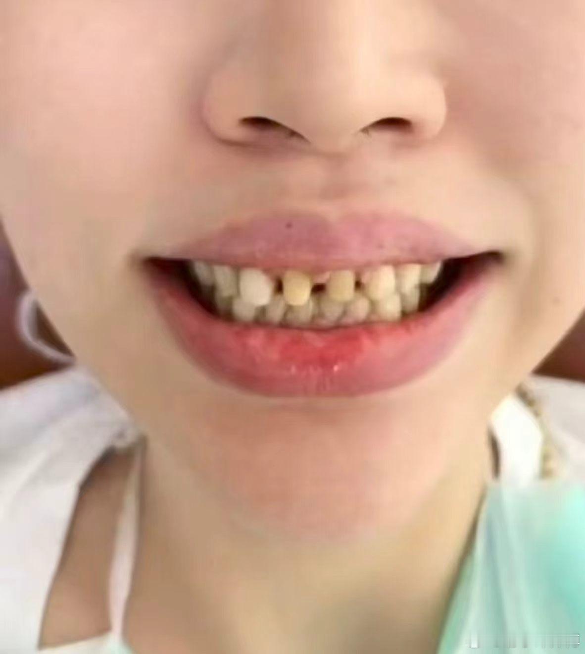 🍃奇门美学面相分享--牙齿🦷牙齿藏财运，门牙稀疏、露牙缝为漏财之相✨    