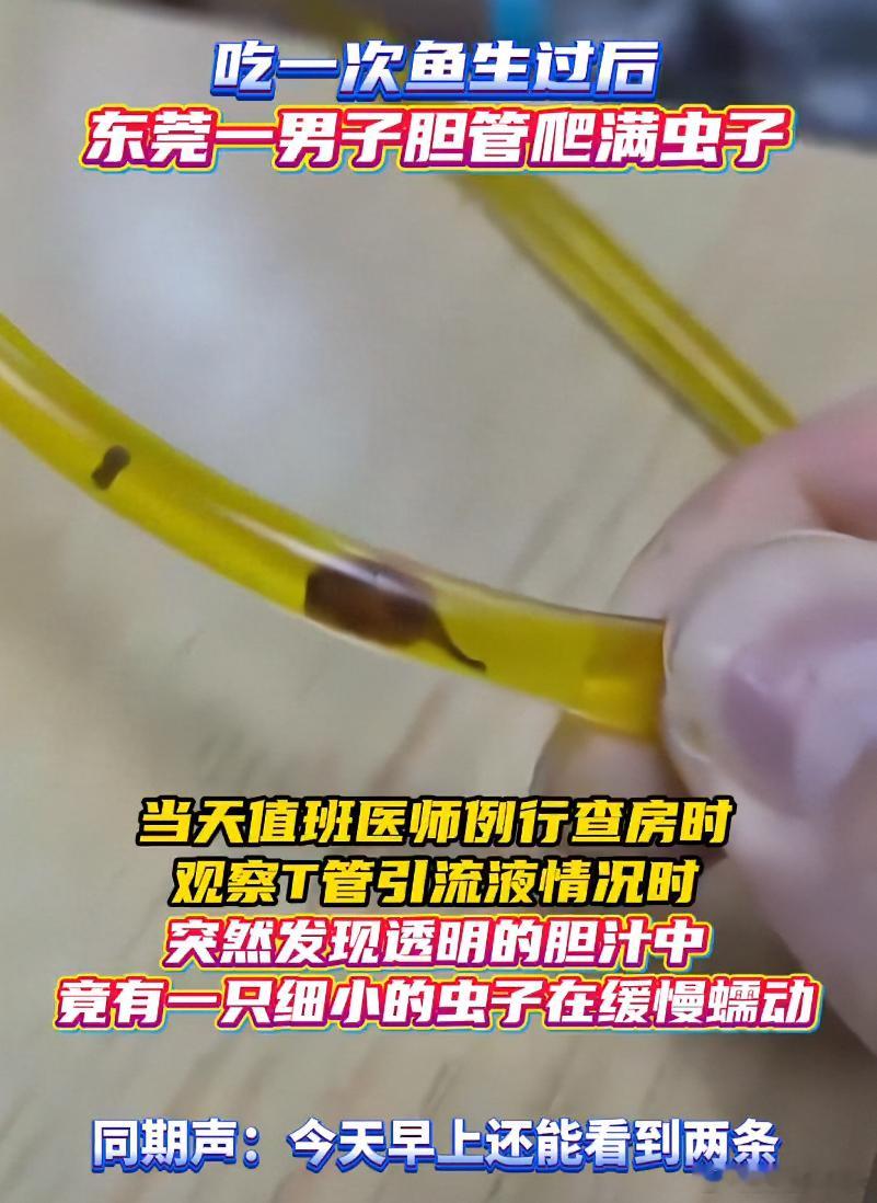 40岁男子吃鱼生后胆管爬满虫子 这以后还哪敢吃了