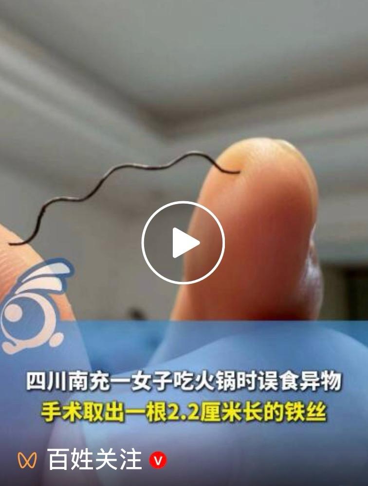 ［惊险就餐！阆中女子吃火锅误食2.2厘米铁丝，喉咙6处划伤全麻手术取出］

6月