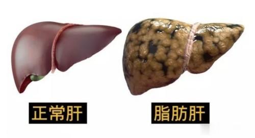 脂肪肝越来越多，这些事千万别做！老王发现好多人一检查都有脂肪肝，不一定胖人才有。