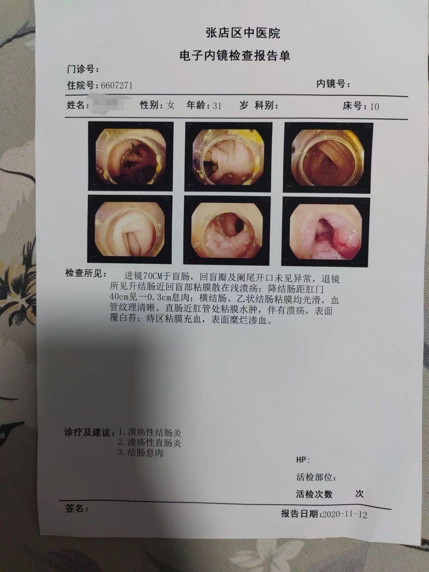 溃疡和溃疡大不同，这是阿米巴原虫感染。  这位患者外院诊断溃直，吃了药...