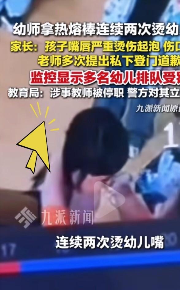 5岁女童被烫伤，父亲拒绝和解：这才是给孩子最后的底牌。幼儿园老师，拿着热熔棒往孩