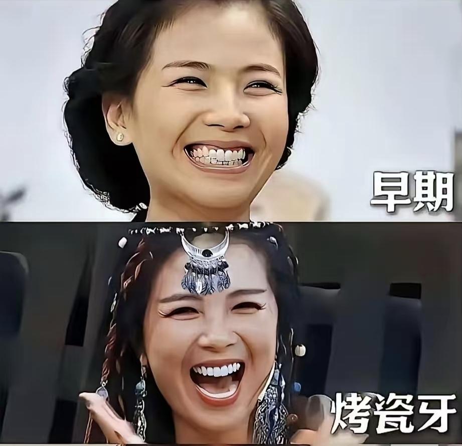 刘涛的这一嘴烤瓷牙太出戏了，
虽说爱美之心人皆有之，
她把所有的牙齿都换成烤瓷牙