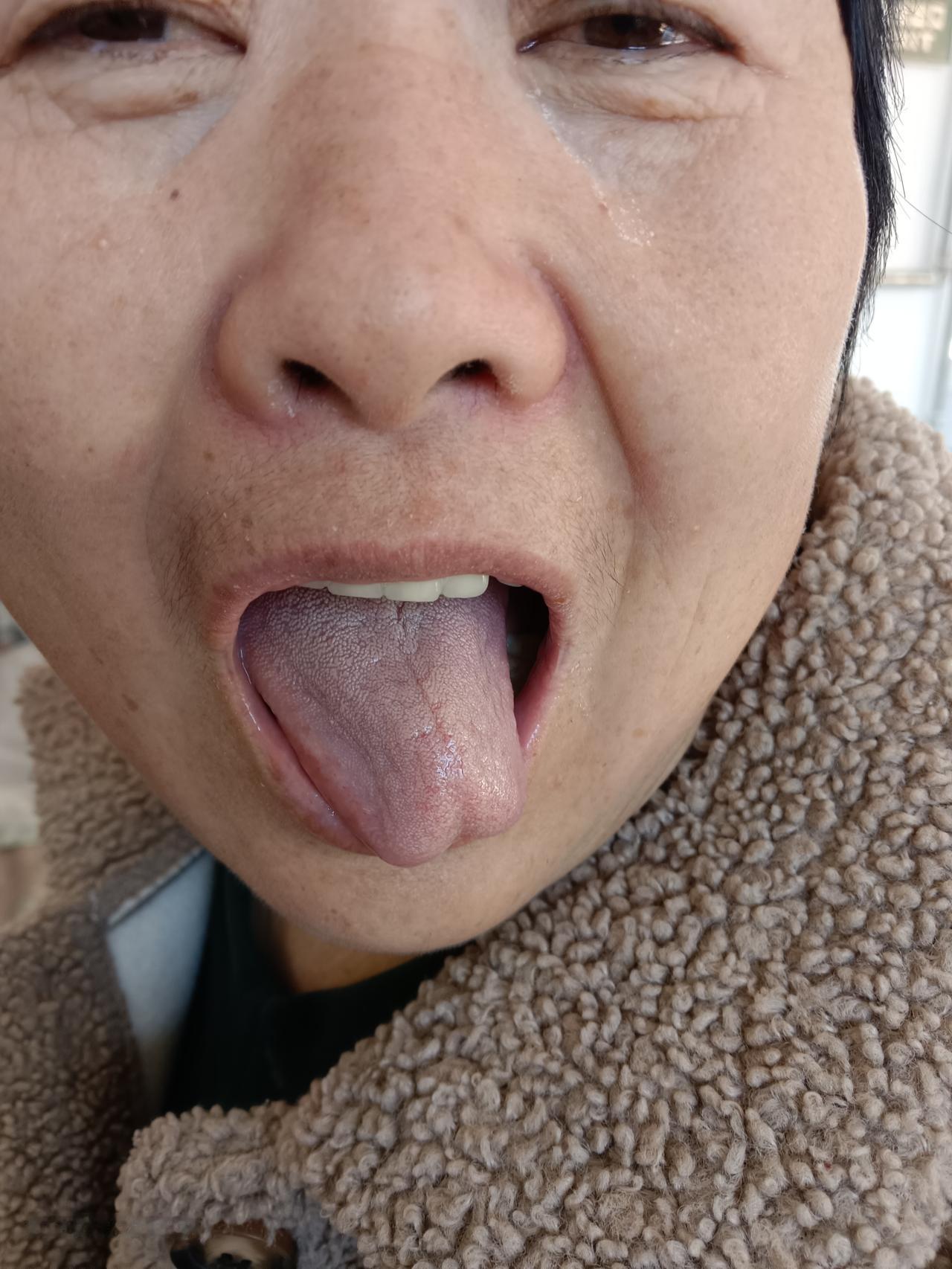 晒图笔记大赛懂中医的来看看这舌头，这是个什么体质的人？