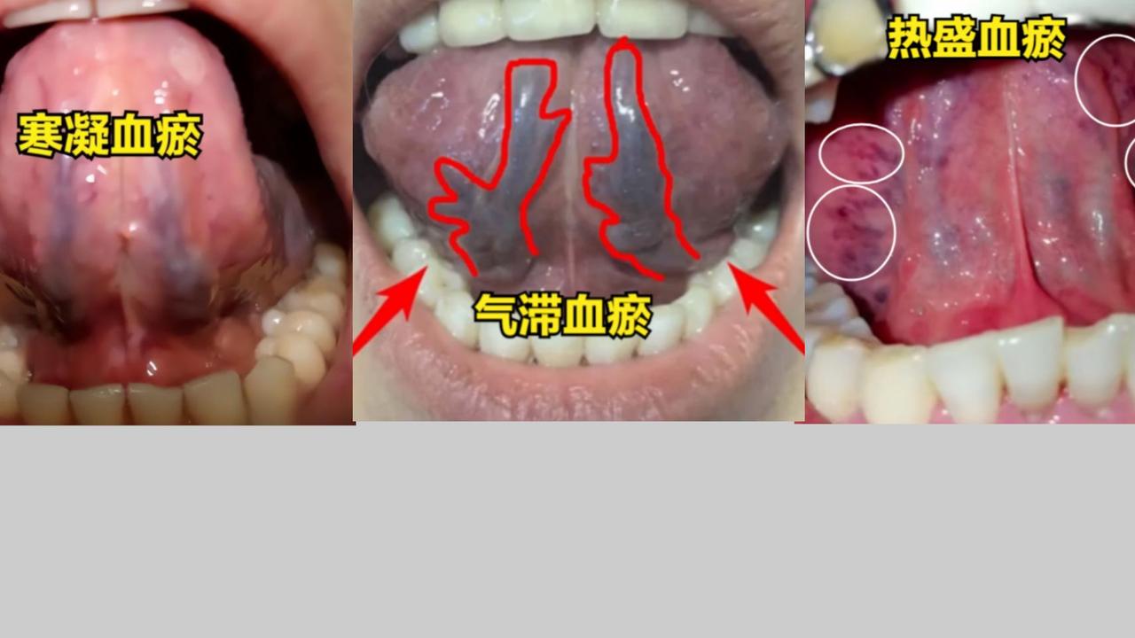 血瘀有5种：气滞血瘀，气虚血瘀，寒凝血瘀，热盛血瘀，痰阻血瘀，对照看看你是属于哪