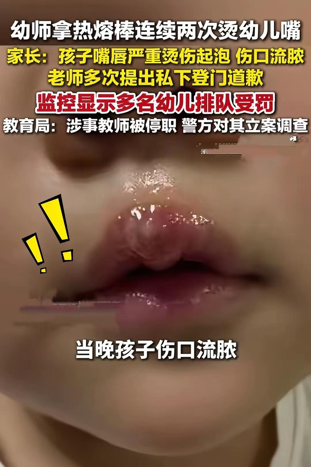 太恶毒了！用热熔枪烫孩子嘴？江苏丰县幼儿园的虐童细节！

​监控画面显示，这根本
