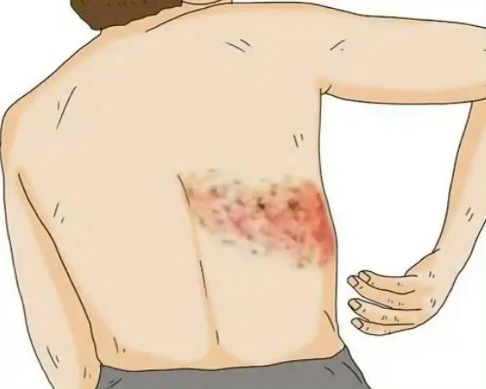 缠腰龙容易缠上糖尿病糖尿病患者真的挺难呀，很容易让带状疱疹趁虚而入，一定要做好血