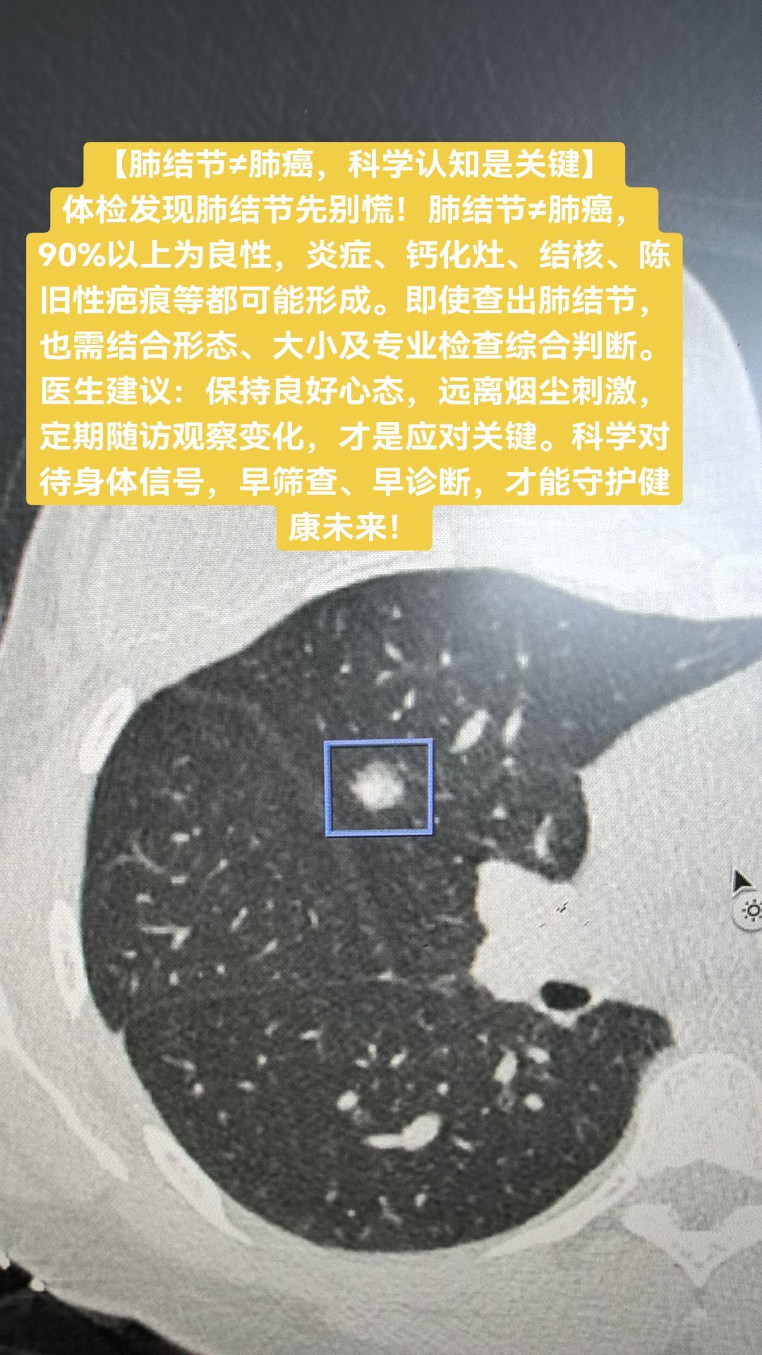 【肺结节≠肺癌，科学认知是关键】【肺结节≠肺癌，科学认知是关键】 体检...