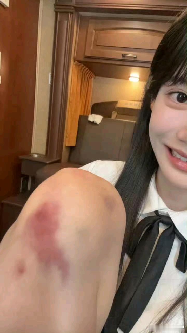 孙珍妮拍戏摔伤，太惨了演一番女主太辛苦了。 
