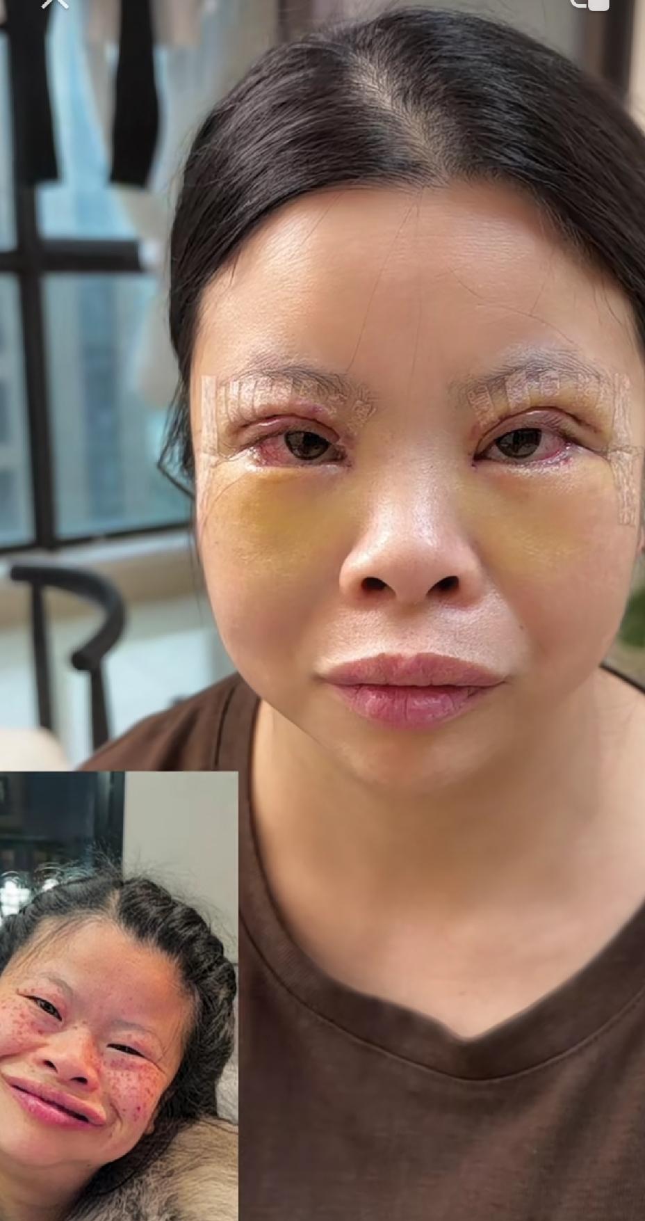 网红琼姐又要逆袭变美了，把眼睛折腾成这样子，看着都痛，为了变美痛也值得。