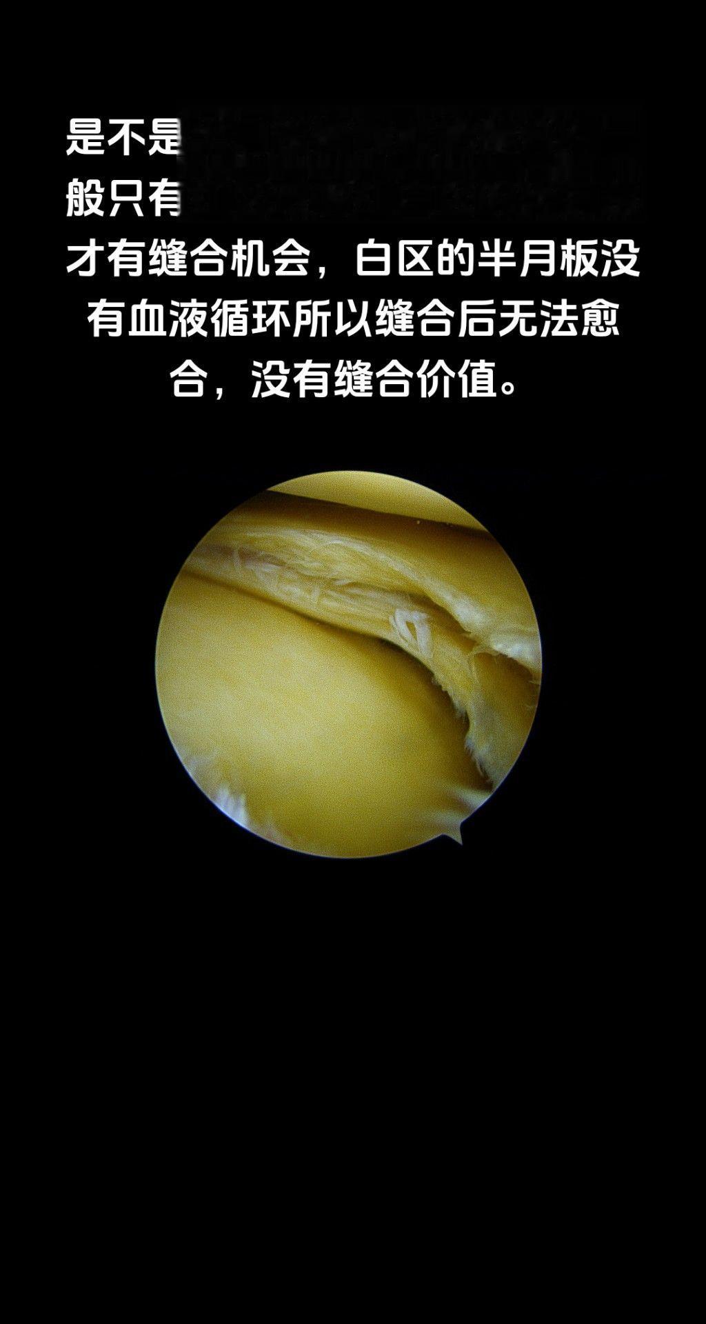 是不是半月板撕裂都能缝合？