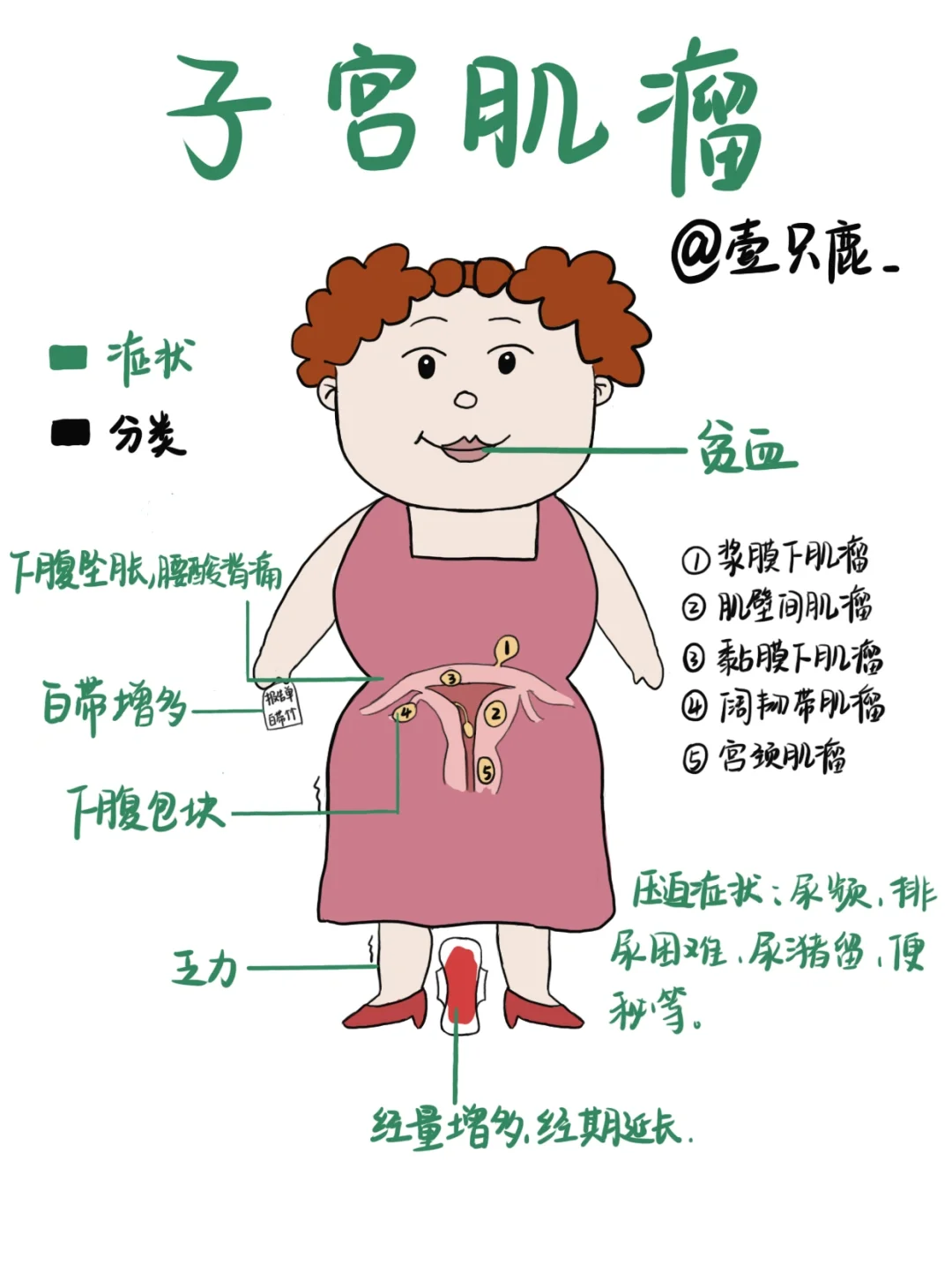 医学生笔记📒｜子宫肌瘤🧐