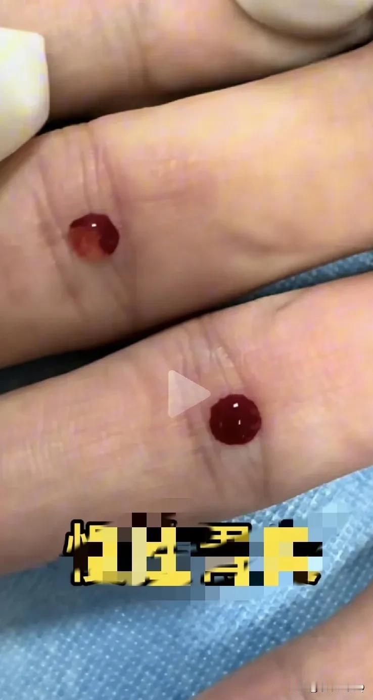 不认可西药的，不认可中药的都很可怜！
今天看病，见证西医中医两大优势，确实缺一不