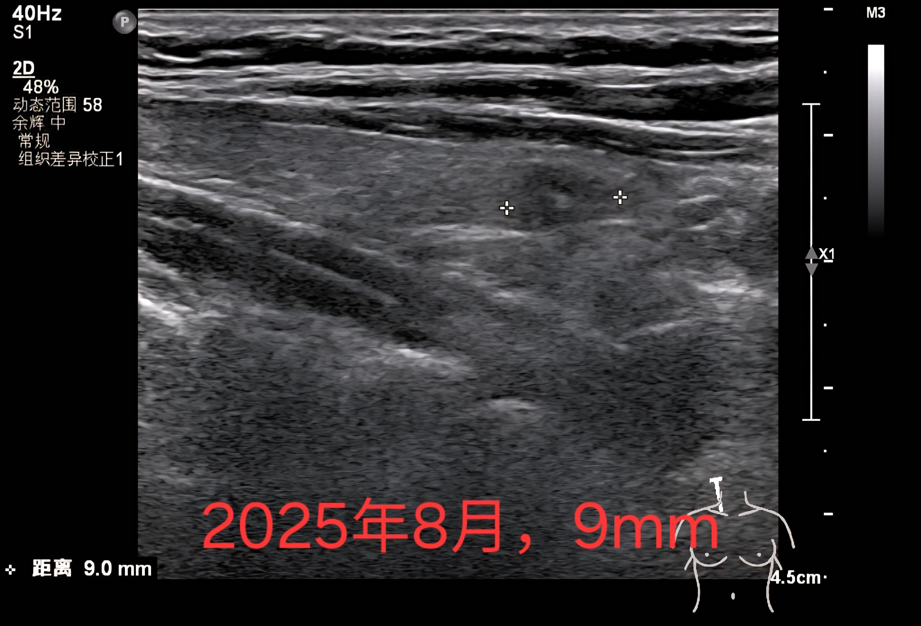 这种甲状腺结节会自己缩小。女48岁。2024年右侧甲状腺结节25×15...