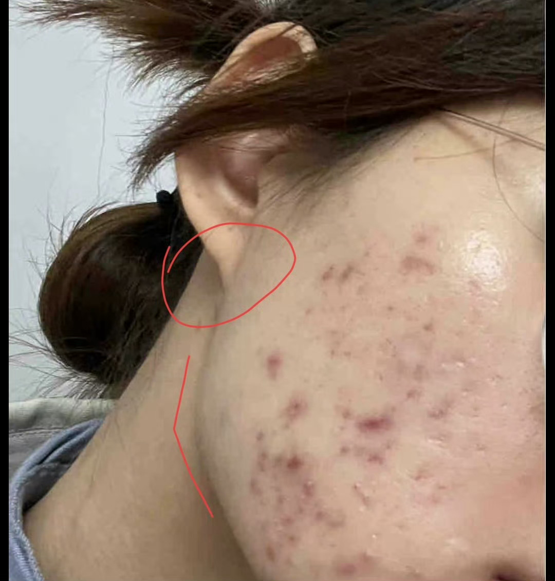 大耳有垂的人会不会更少见有长痘痘的 
