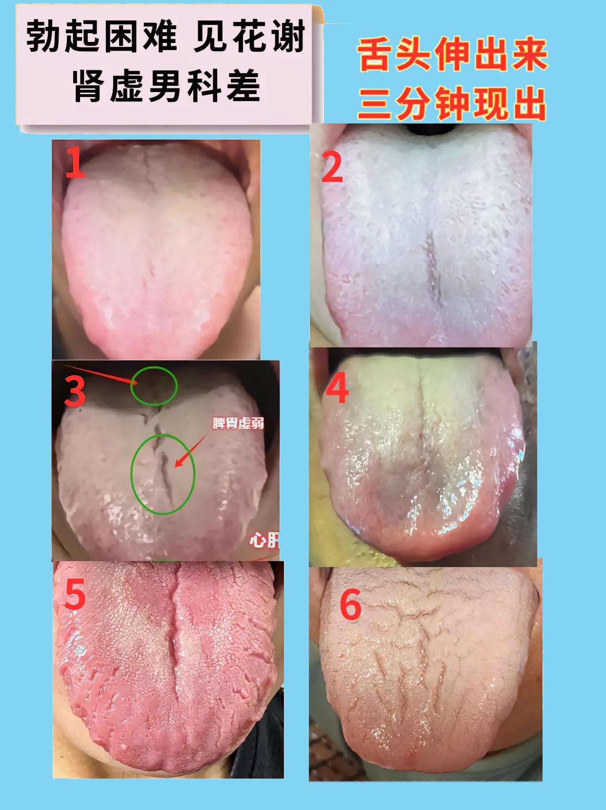 舌头一伸，原型必露！瞒不过中医的火眼金睛

尤其是这6种常见的男科不及格舌象！