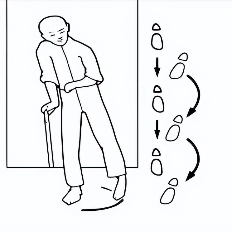 偏瘫走路老摔跤？找对原因很重要
 
在偏瘫患者学走路的过程中，我们经常会看到他们