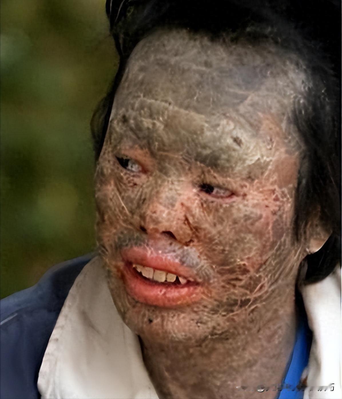 男子吃蛇太多竟变蛇人！辽宁一村民生吃蛇胆后竟浑身长满鳞片，还开始蜕皮……
 
韩