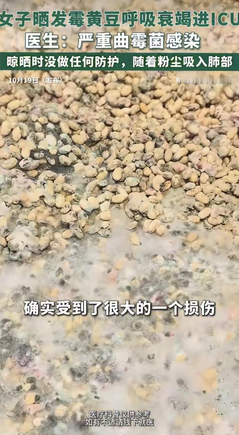 河南郑州一位50岁大姐，在家收拾发霉黄豆时没戴口罩，直接上手搓霉斑。结果霉菌粉尘
