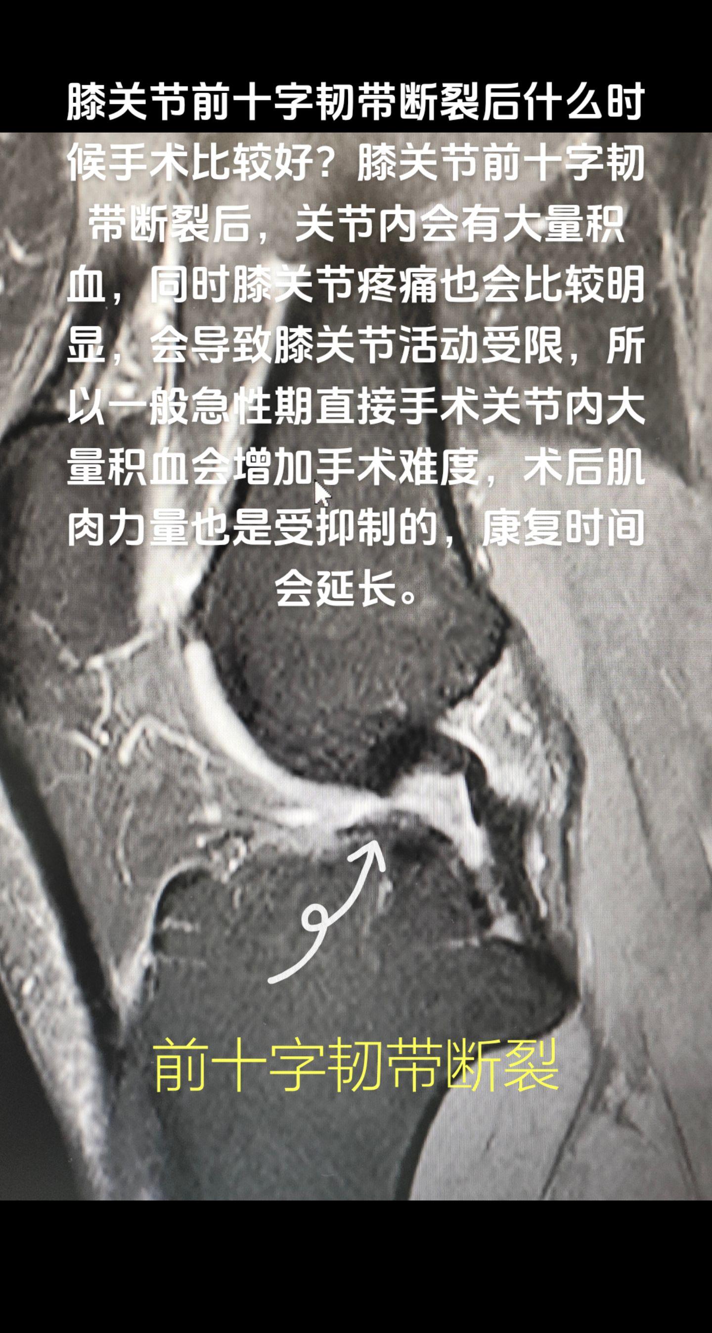 前交叉韧带断裂什么时候手术？前交叉韧带重建
