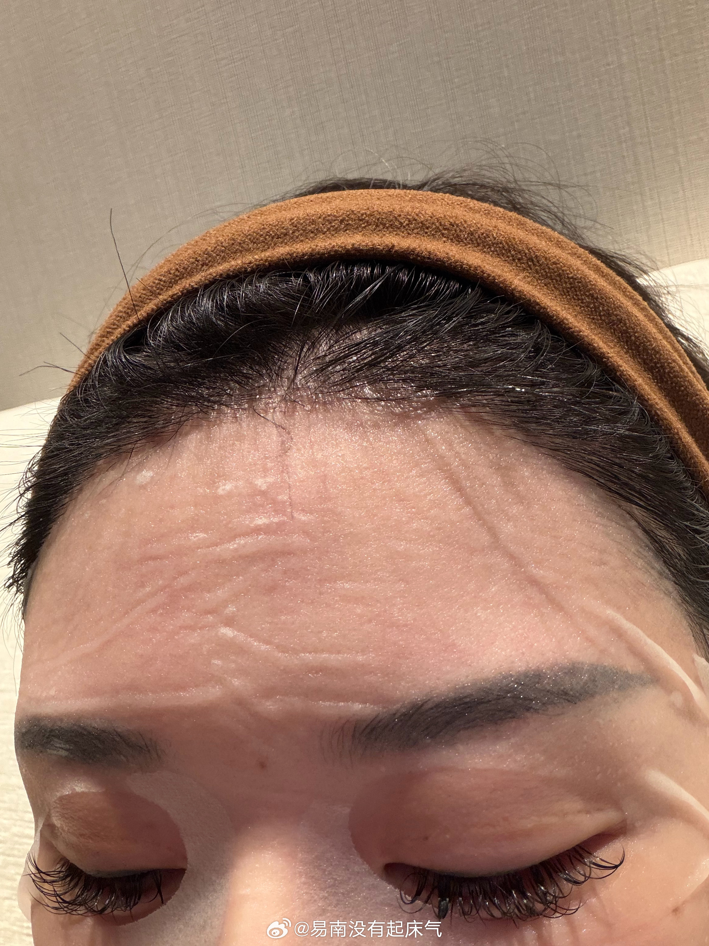 发际线快快长长 想梳大光明 