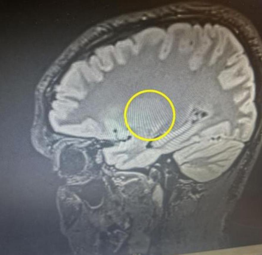 【误诊之痛：14岁少年的脑瘤噩梦】英媒报道，北安普敦郡科比市的斯蒂芬·霍尔遭遇了